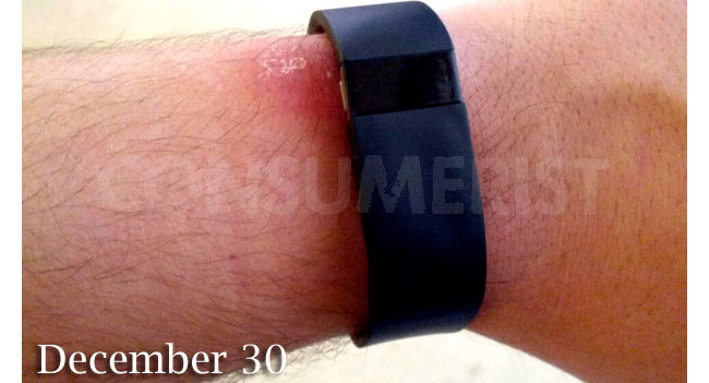 Деякі власники недавно представленого браслета   Fitbit Force   зіткнулися з проблемою, у них на шкірі почали проявлятися алергічні реакції